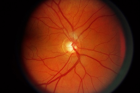 青光眼,希瑪瑞視眼科,上海眼科醫院 青光眼,希瑪瑞視眼科,上海眼科醫院