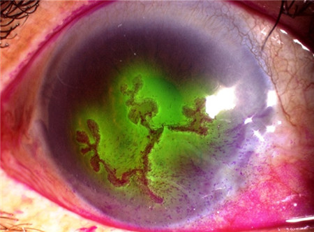 眼表眼角膜,希瑪瑞視眼科,上海眼科醫院