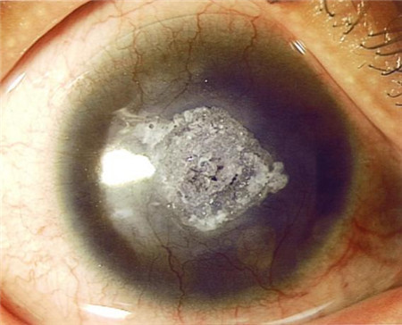 眼表眼角膜,希瑪瑞視眼科,上海眼科醫院