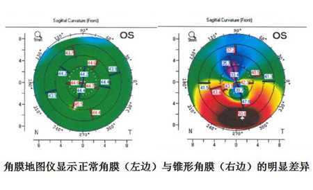 眼表眼角膜,希瑪瑞視眼科,上海眼科醫院