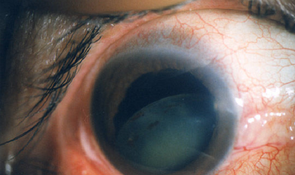 白內障,希瑪瑞視眼科,上海眼科醫院 白內障,希瑪瑞視眼科,上海眼科醫院