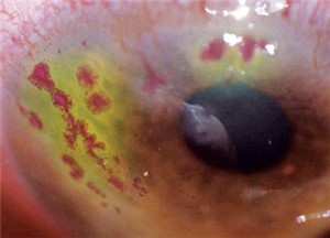 眼表眼角膜,?，斎鹨曆劭?上海眼科醫院