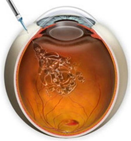 玻璃體視網膜,希瑪瑞視眼科,上海眼科醫院 玻璃體視網膜,希瑪瑞視眼科,上海眼科醫院