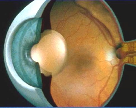 白內障,希瑪瑞視眼科,上海眼科醫院 白內障,希瑪瑞視眼科,上海眼科醫院