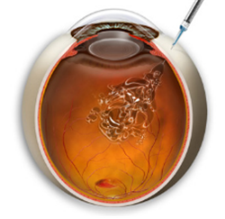 玻璃體視網(wǎng)膜