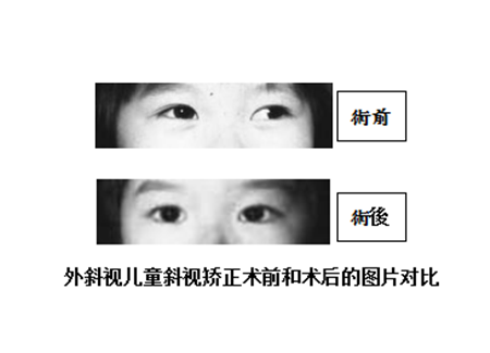 小兒眼病