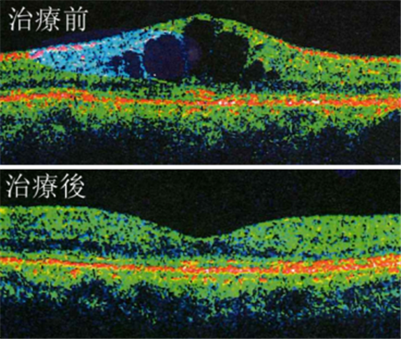 玻璃體視網膜,希瑪瑞視眼科,上海眼科醫院 玻璃體視網膜,希瑪瑞視眼科,上海眼科醫院