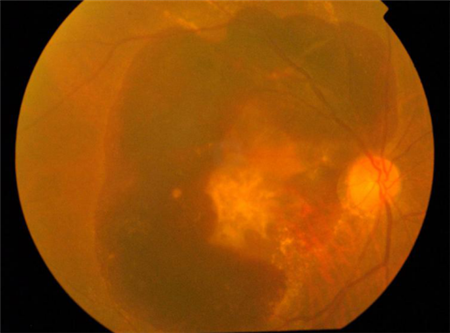 眼表眼角膜,?，斎鹨曆劭?上海眼科醫(yī)院