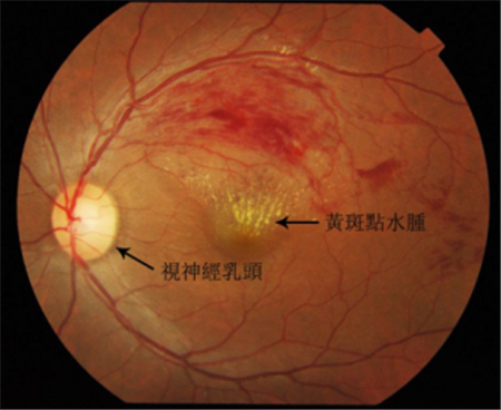 玻璃體視網膜,?，斎鹨曆劭?上海眼科醫院