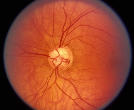 青光眼,希瑪瑞視眼科,上海眼科醫院 青光眼,希瑪瑞視眼科,上海眼科醫院