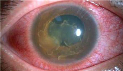 眼表眼角膜,希瑪瑞視眼科,上海眼科醫院 眼表眼角膜,希瑪瑞視眼科,上海眼科醫院