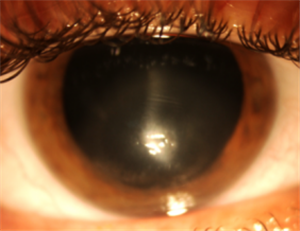 眼表眼角膜,希瑪瑞視眼科,上海眼科醫(yī)院 眼表眼角膜,希瑪瑞視眼科,上海眼科醫(yī)院