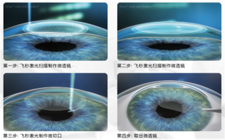 屈光矯視,希瑪瑞視眼科,上海眼科醫(yī)院