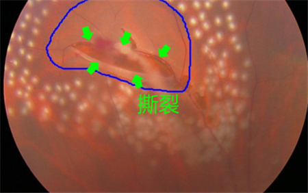 玻璃體視網(wǎng)膜,希瑪瑞視眼科,上海眼科醫(yī)院 玻璃體視網(wǎng)膜,希瑪瑞視眼科,上海眼科醫(yī)院