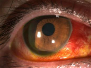 玻璃體視網(wǎng)膜,希瑪瑞視眼科,上海眼科醫(yī)院 玻璃體視網(wǎng)膜,希瑪瑞視眼科,上海眼科醫(yī)院