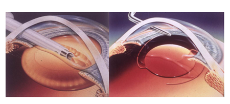 眼表眼角膜,希瑪瑞視眼科,上海眼科醫院 眼表眼角膜,希瑪瑞視眼科,上海眼科醫院