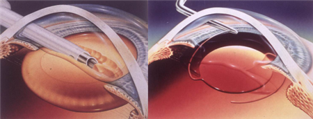 白內障,希瑪瑞視眼科,上海眼科醫院 白內障,希瑪瑞視眼科,上海眼科醫院