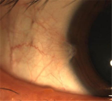 眼表眼角膜,希瑪瑞視眼科,上海眼科醫(yī)院 眼表眼角膜,希瑪瑞視眼科,上海眼科醫(yī)院