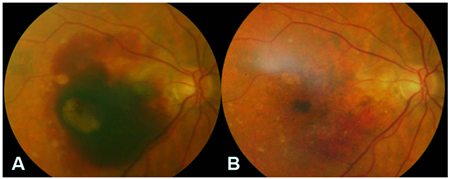 玻璃體視網(wǎng)膜,希瑪瑞視眼科,上海眼科醫(yī)院 玻璃體視網(wǎng)膜,希瑪瑞視眼科,上海眼科醫(yī)院
