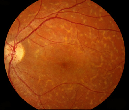 玻璃體視網(wǎng)膜