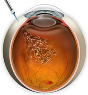 玻璃體視網(wǎng)膜