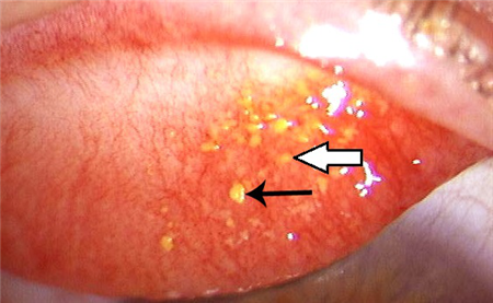 眼表眼角膜,希瑪瑞視眼科,上海眼科醫院 眼表眼角膜,希瑪瑞視眼科,上海眼科醫院