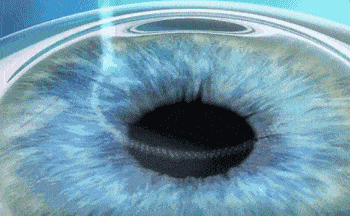 屈光矯視,希瑪瑞視眼科,上海眼科醫院