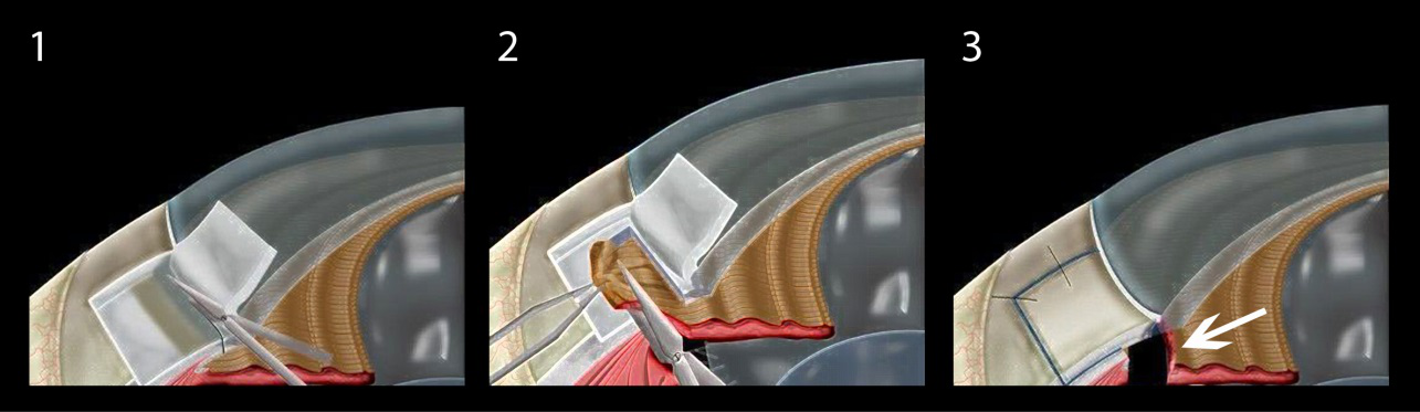 青光眼,希瑪瑞視眼科,上海眼科醫(yī)院 青光眼,希瑪瑞視眼科,上海眼科醫(yī)院