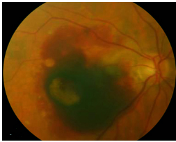 玻璃體視網膜,希瑪瑞視眼科,上海眼科醫院 玻璃體視網膜,希瑪瑞視眼科,上海眼科醫院