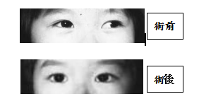 小兒眼病,希瑪瑞視眼科,上海眼科醫院