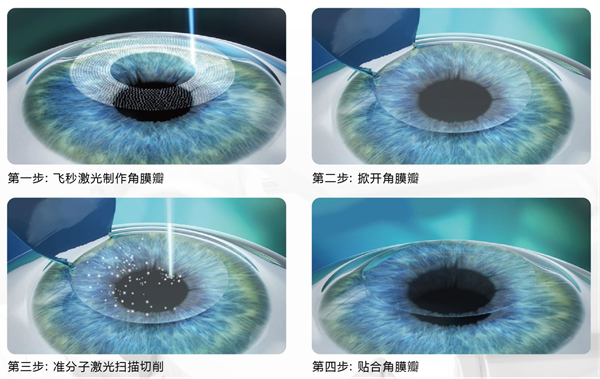 屈光矯視,希瑪瑞視眼科,上海眼科醫院 屈光矯視,希瑪瑞視眼科,上海眼科醫院