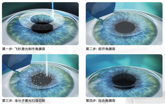 屈光矯視,希瑪瑞視眼科,上海眼科醫(yī)院 屈光矯視,希瑪瑞視眼科,上海眼科醫(yī)院