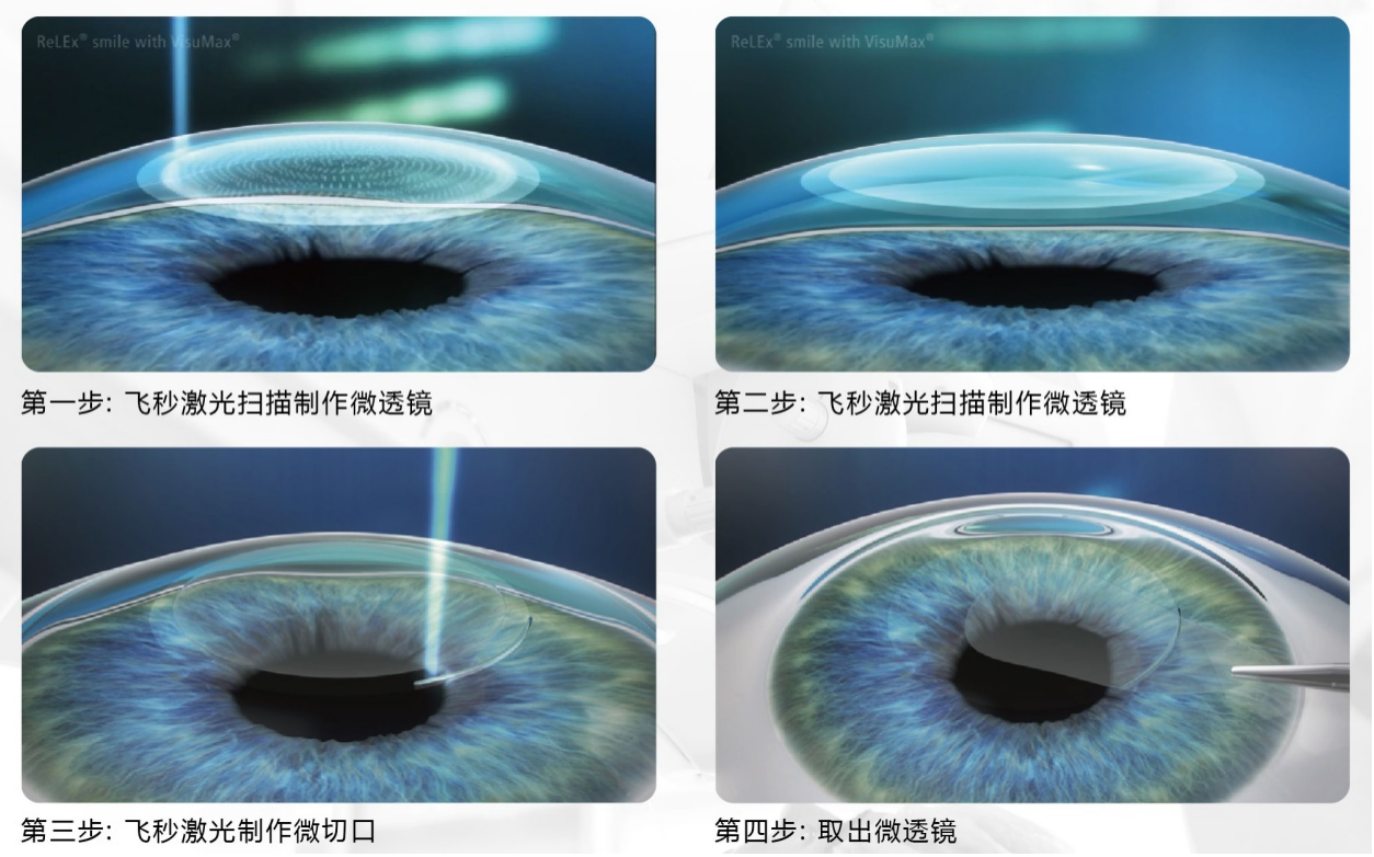 屈光矯視,希瑪瑞視眼科,上海眼科醫(yī)院