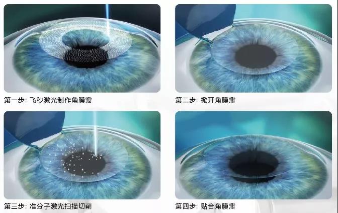 屈光矯視,希瑪瑞視眼科,上海眼科醫院