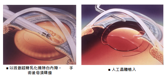 白內障,希瑪瑞視眼科,上海眼科醫院 白內障,希瑪瑞視眼科,上海眼科醫院